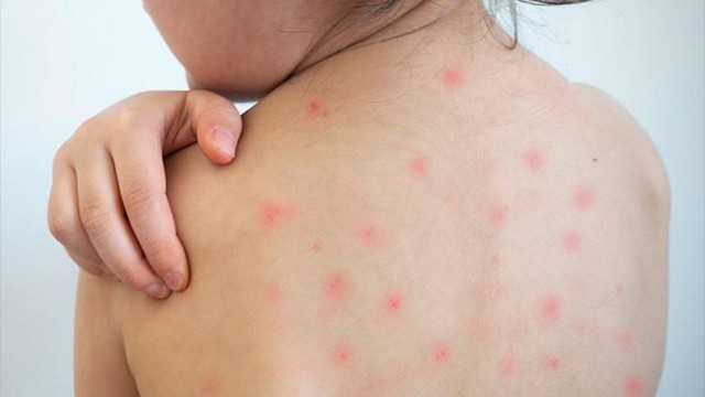 হাম ও হামের উপসর্গে মৃত্যু সাড়ে ৬শ ছুঁইছুঁই