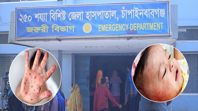 চাঁপাইনবাবগঞ্জে বাড়ছে হামের প্রকোপ: জেলা হাসপাতালে বর্তমানে ভর্তি ৫৮ শিশু